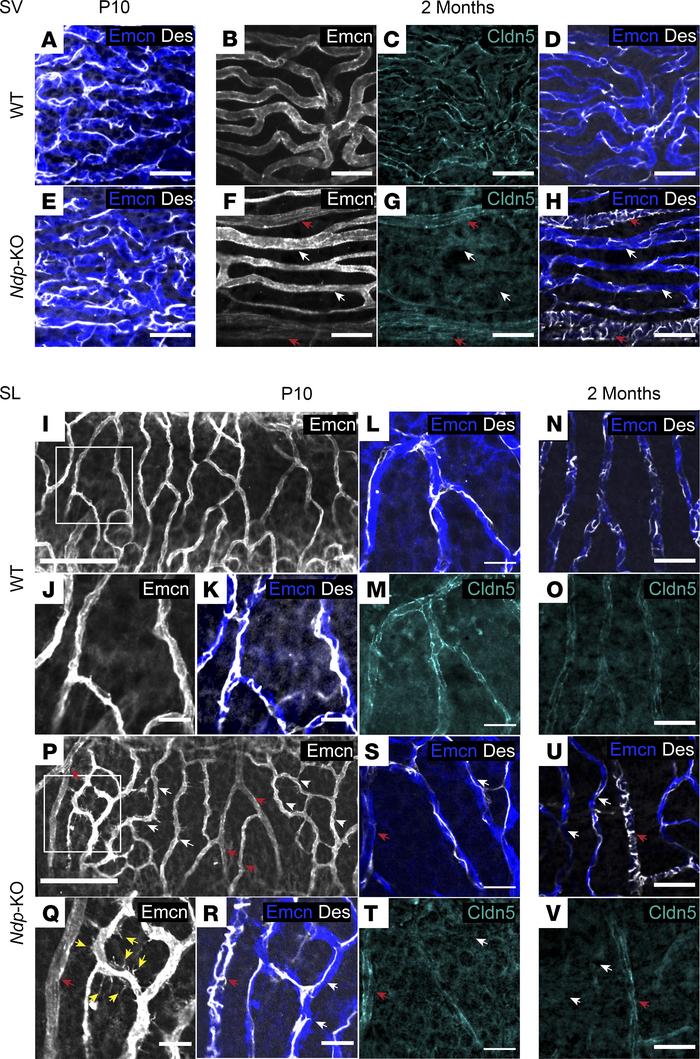 Abnormal pericyte coverage of capillaries in the lateral wall affecting ...