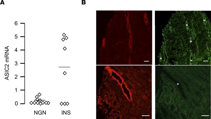 Expression of ASIC2 in nephrotic patients.
(A) RT-qPCR analysis of ASIC2...