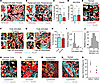 PDA cell extrusion into periductal collagen architectures.