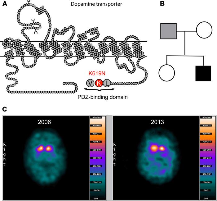 Identification of DAT-K619N in a patient with atypical parkinsonism and ...