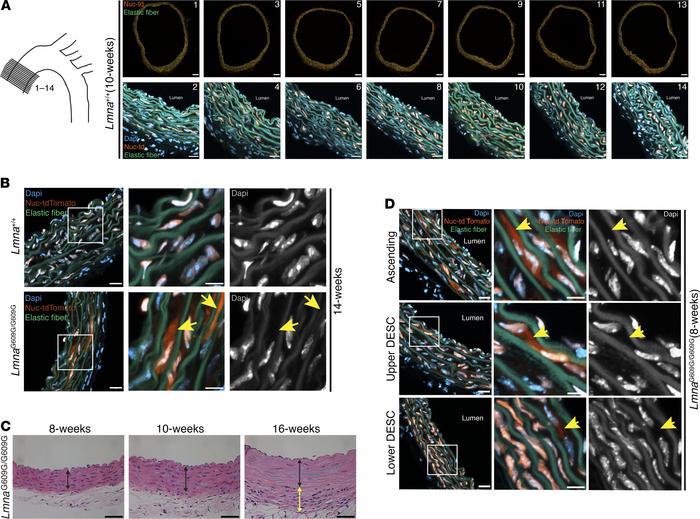 NM ruptures in aortic SMCs precede SMC loss in LmnaG609G/G609G mice.
(A)...