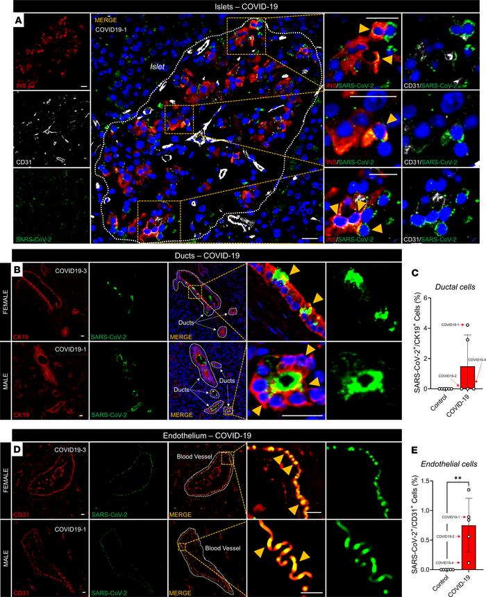 SARS-CoV-2 infects pancreatic endocrine, exocrine, and endothelial cells...