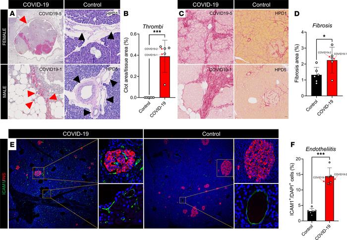 SARS-CoV-2 infection is associated with thrombofibrosis in humans.
(A) R...