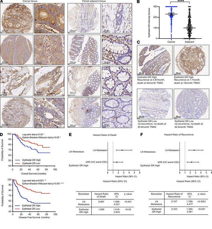 High intestinal epithelial GR expression is associated with poor prognos...