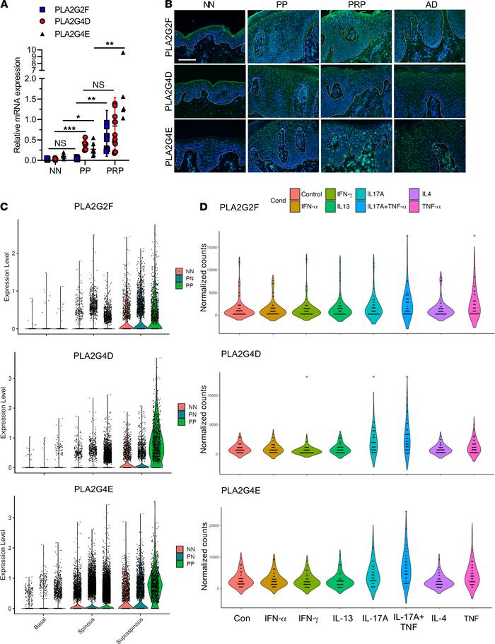 PLA2s are highly expressed in the epidermis of psoriatic lesions and TNF...