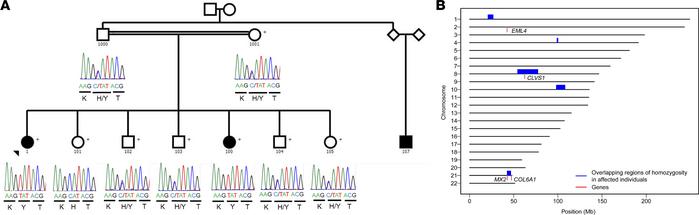
CLVS1 p.H310Y is a potential cause of familial childhood SSNS.
(A) Pedi...