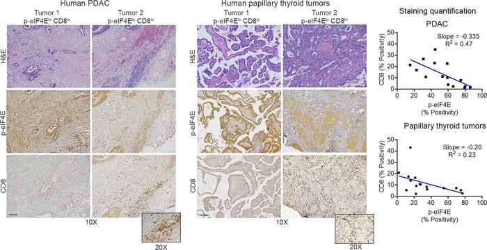 Increased MNK activity correlates with decreased CD8+ T cell infiltratio...