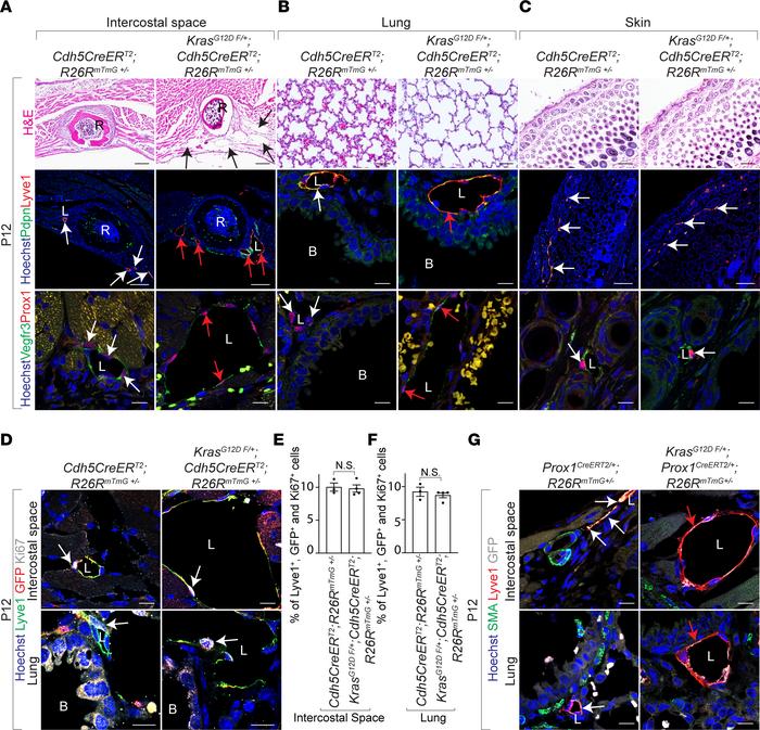 Lymphatic endothelial KRASG12D mutation drives lymphangiectasia.
(A–C) H...