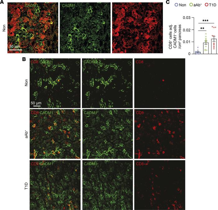 Increased number of CADM1+ cells adjacent to CD8+ T cells in the exocrin...