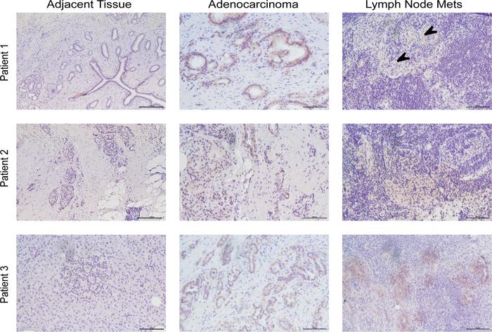 PERP is elevated in human pancreatic cancer.
Representative images of PE...