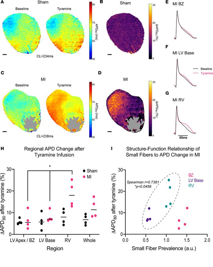 Altered neuroeffector distribution underlies perturbed myocardial sympat...