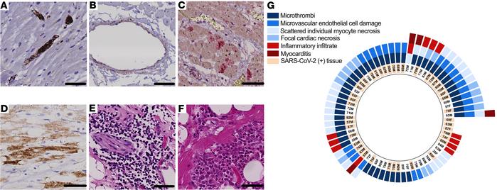 Acute cardiac histopathologic features in fatal COVID-19.
(A) Microthrom...