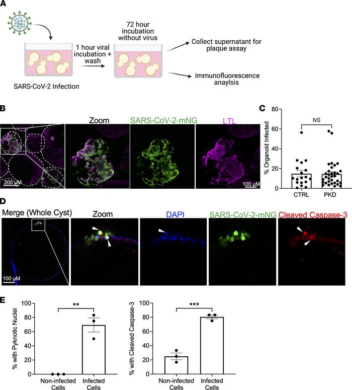SARS-CoV-2 infects PKD organoid cystic epithelium.
(A) Schematic of cyst...