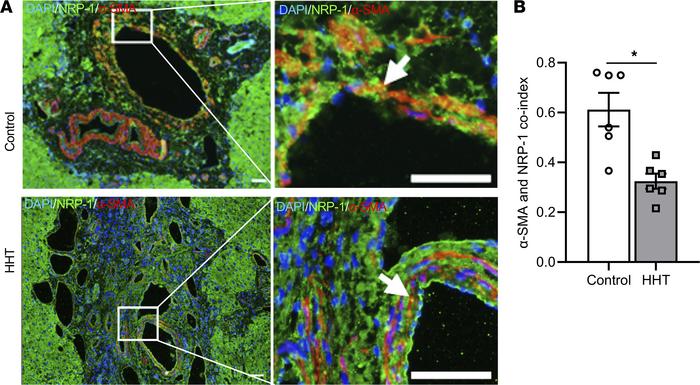 NRP-1 expression in liver sections from patients with HHT and controls.
...