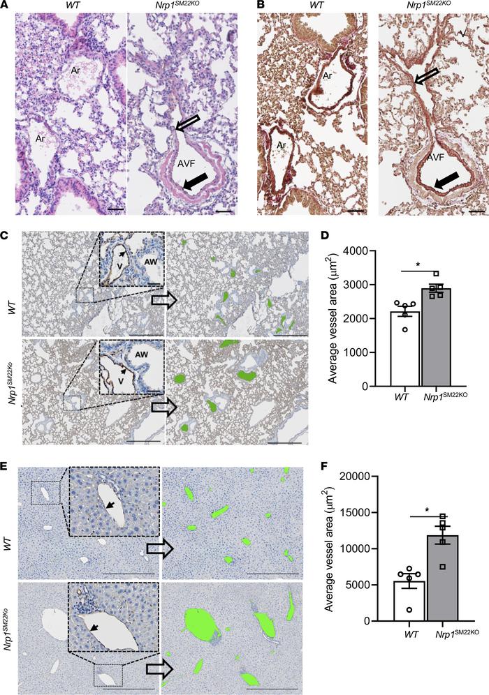 Direct connection of artery to vein in the lung and dilated vessels in l...