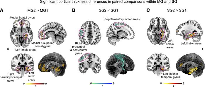 Cortical thickness analyses.
(A–C) There were only significant differenc...