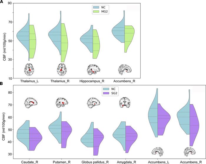 Subcortical nuclei with significant CBF differences between groups.
(A a...