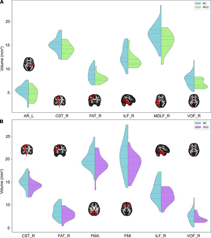 White matter tracts with significant volumetric differences in patients ...
