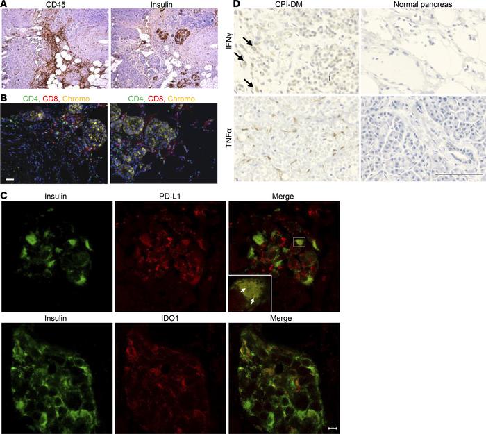 Evidence of inflammation in pancreatic tissue from a patient with CPI-DM...