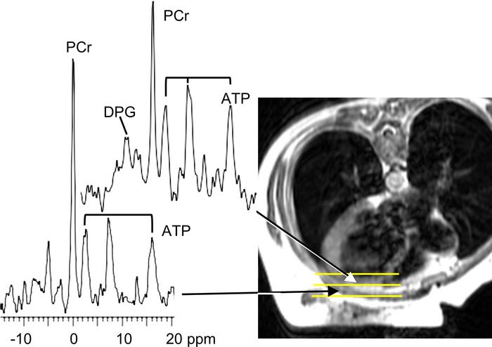 Representative CMR image and 31P MR spectra.
Representative axial MRI (r...
