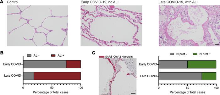 Histopathological findings in early and late COVID-19 mortality.
(A) H&a...