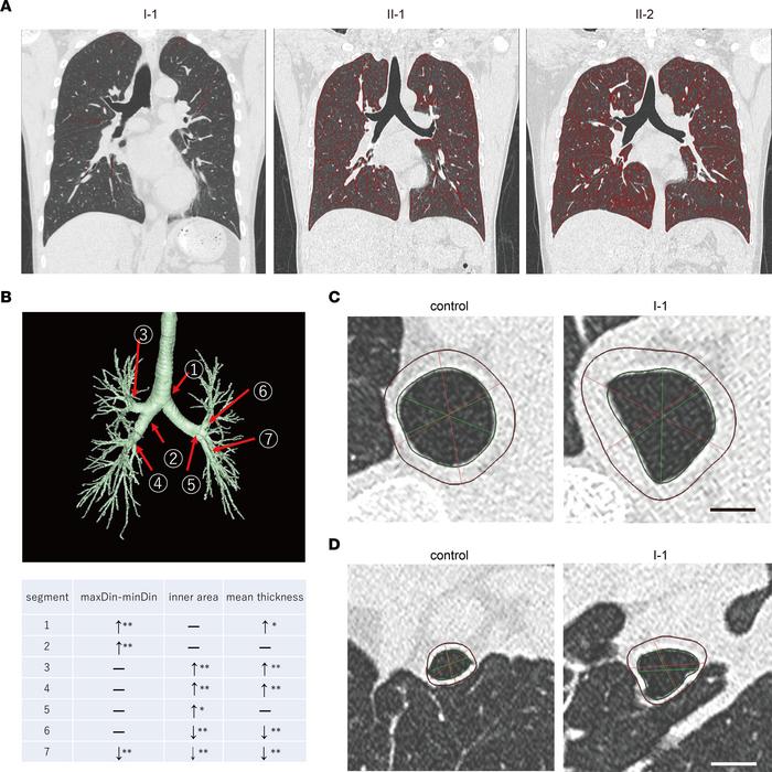 Extrarenal phenotypes of patients.
(A) Emphysematous changes in patients...