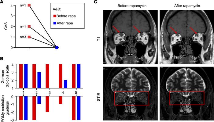 Rapamycin improves orbitopathy and diplopia in patients with refractory ...