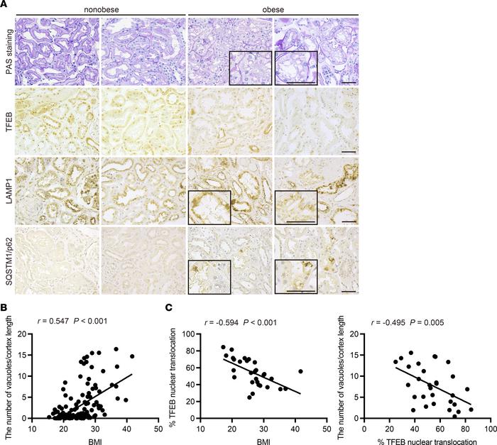 Higher BMI is associated with increased vacuolation and decreased nuclea...