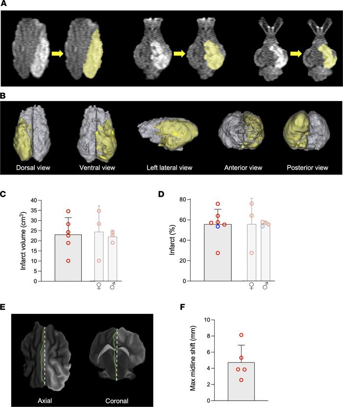 Infarct volume and midline shift determination through MRI.
(A and B) 3D...