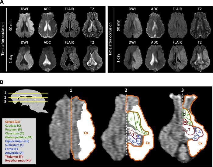 MRI differences between time points and brain regions affected.
(A) Repr...