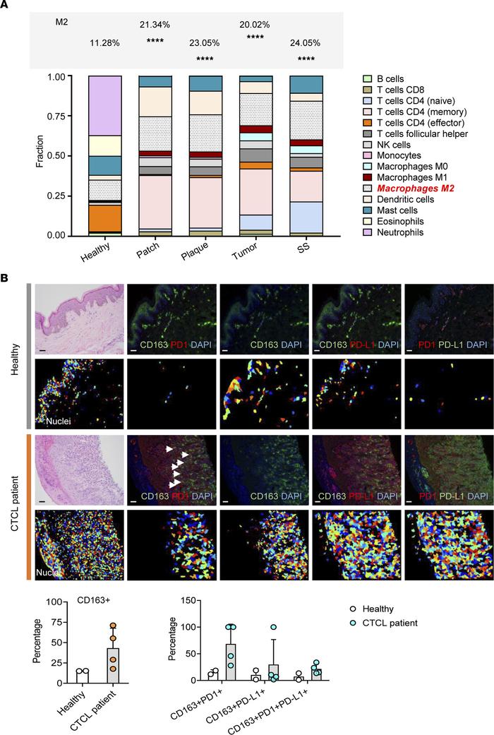 M2-like TAMs are abundant within the TME of CTCL.
(A) CIBERSORT analysis...