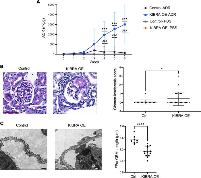 Podocyte-specific overexpression of KIBRA increases podocyte injury in A...
