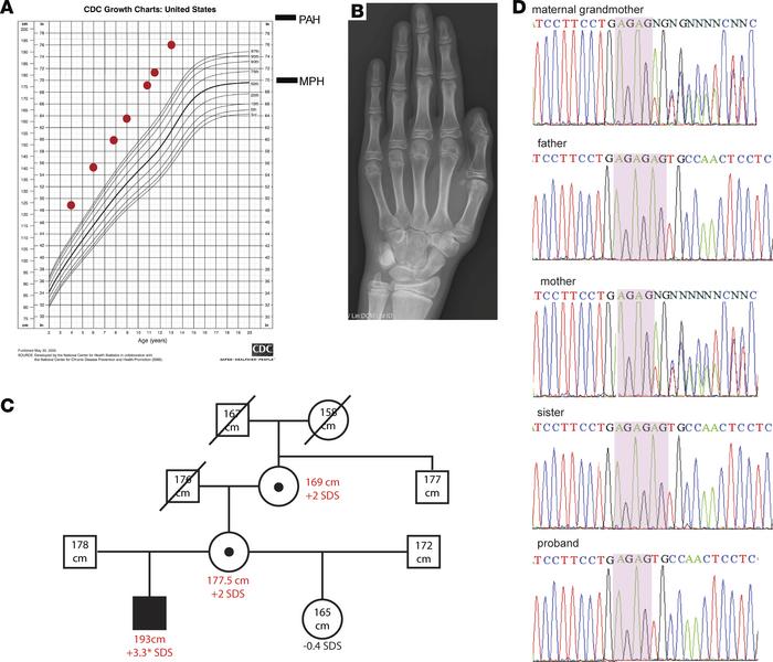 Patient with a new overgrowth syndrome.
(A) Proband’s growth chart for s...