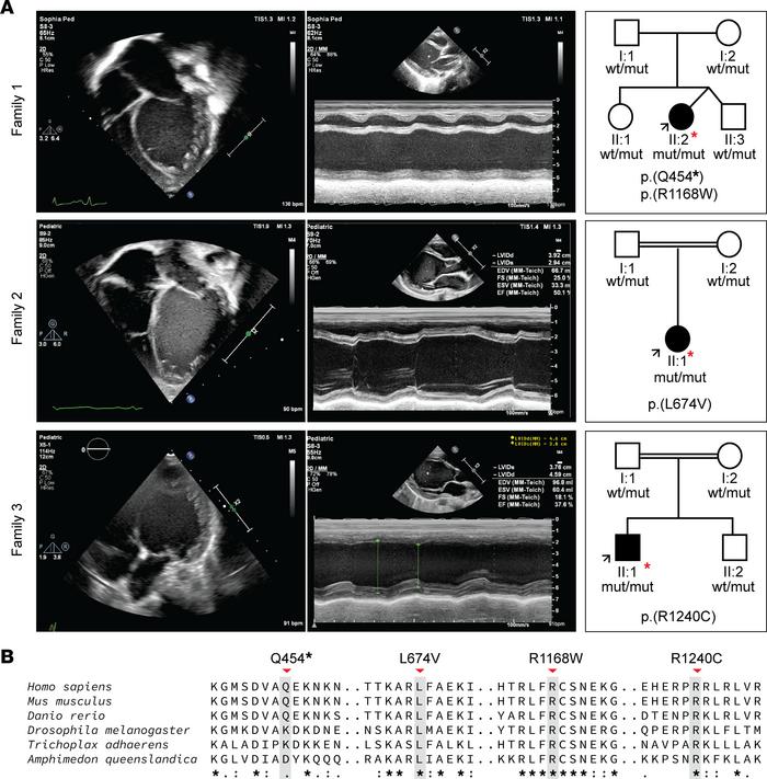 Clinical manifestation of early-onset DCM and family pedigree of affecte...