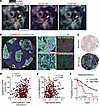 Patient NSCLC tumors show Spon1+ TIMs, and LRP8 expression on cancer cells