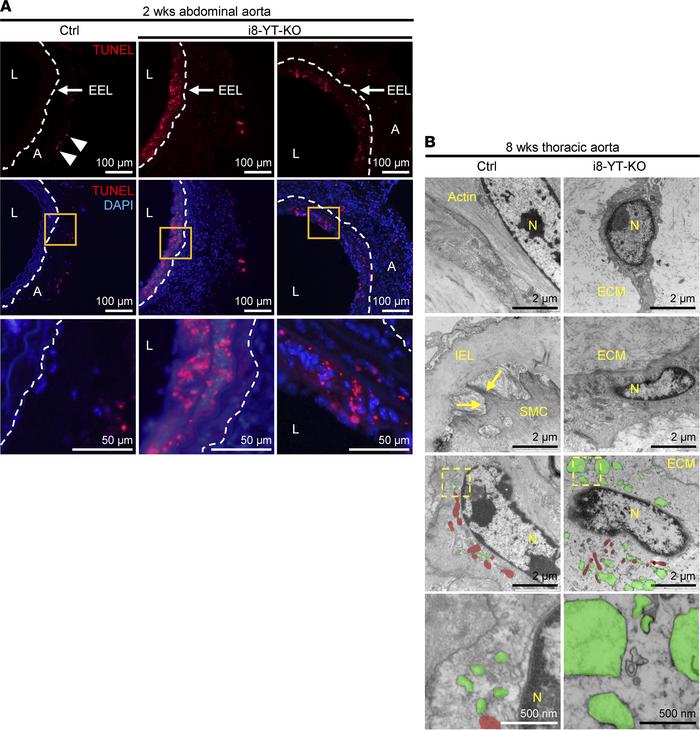 Abdominal aortic aneurysms show medial apoptosis and ultrastructural cha...