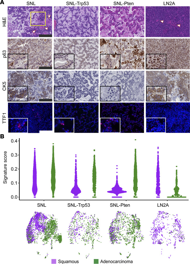 Genetic regulation of squamous or adenocarcinoma transdifferentiation of...