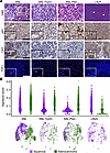 Genetic regulation of squamous or adenocarcinoma transdifferentiation of NS