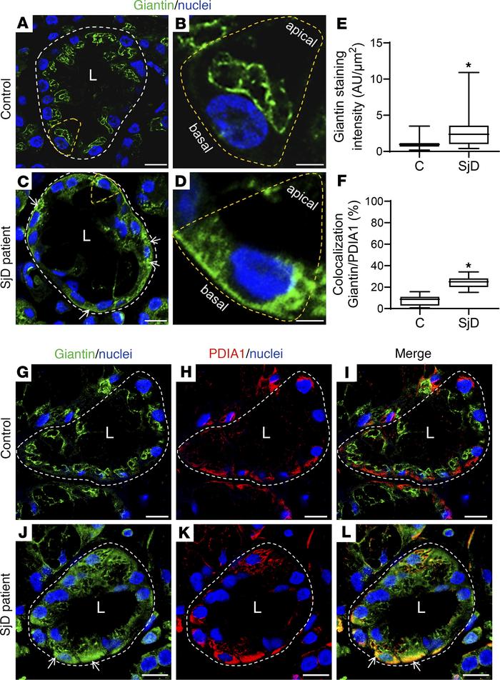 Increased Giantin protein levels in LSGs from patients with SjD.
(A–D) R...