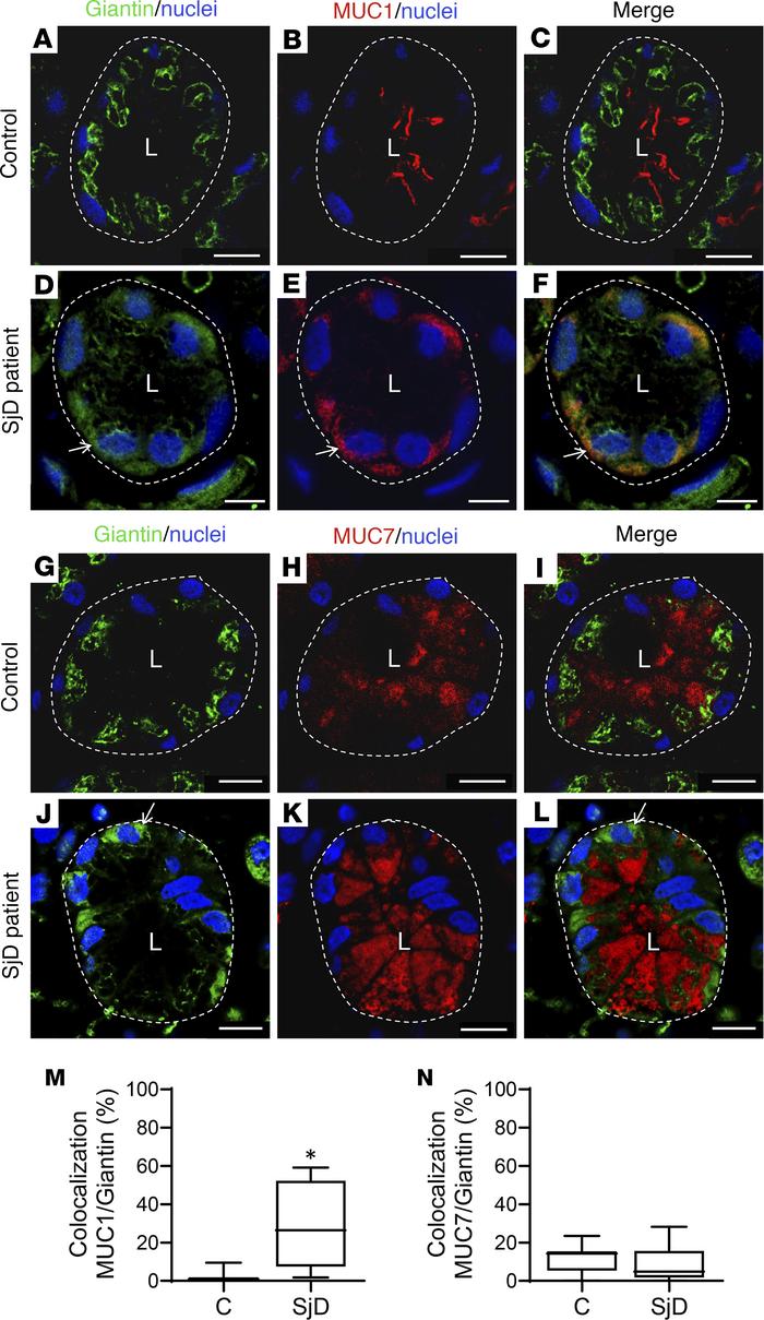 Altered localization of Giantin and mucins in LSGs from patients with Sj...