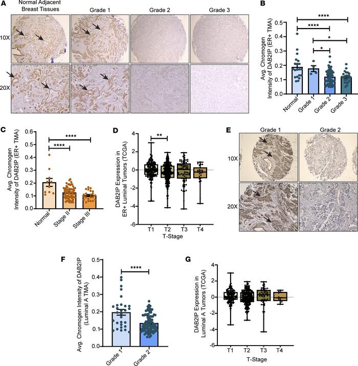 DAB2IP expression decreases with increasing tumor grade and stage in hum...