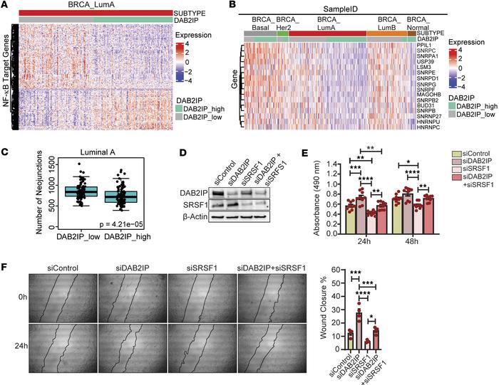 Effect of low DAB2IP on NF-κB target genes in Luminal A breast tumors.
(...