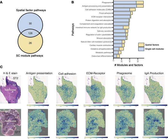Combinatorial single-cell and spatial transcriptomics depict heterogeneo...