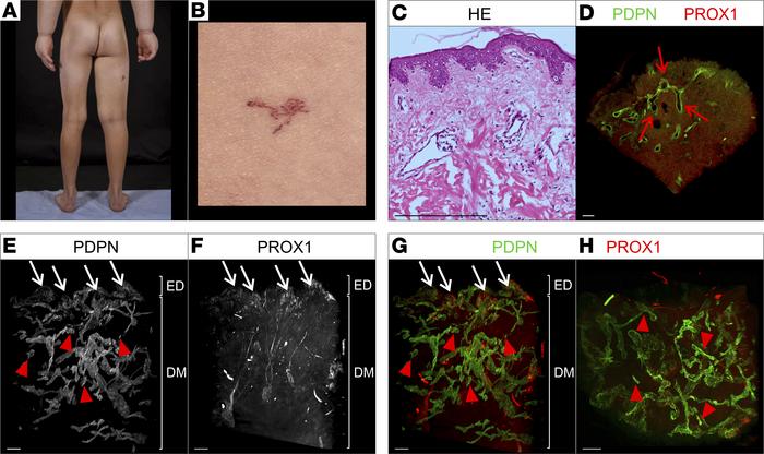 Macroscopic as well as 2D and 3D microscopic manifestations of a patient...