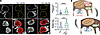 mTORC1 overactivation is associated with increased DNA damage accumulation