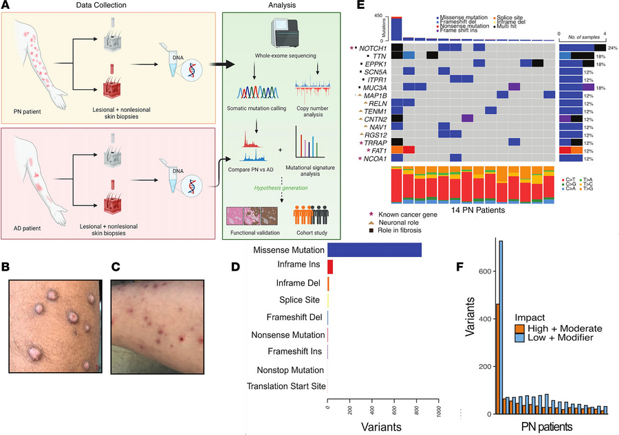 Somatic mutational landscape of PN.
(A) Schematic of the study design, i...
