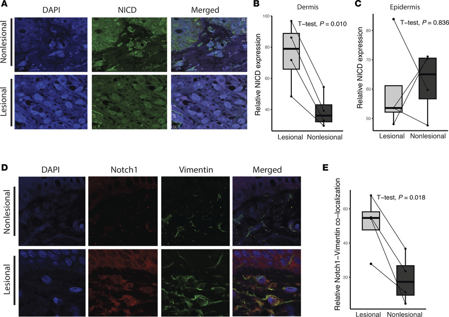 Notch signaling is activated in lesional skin of patients with PN.
(A) I...