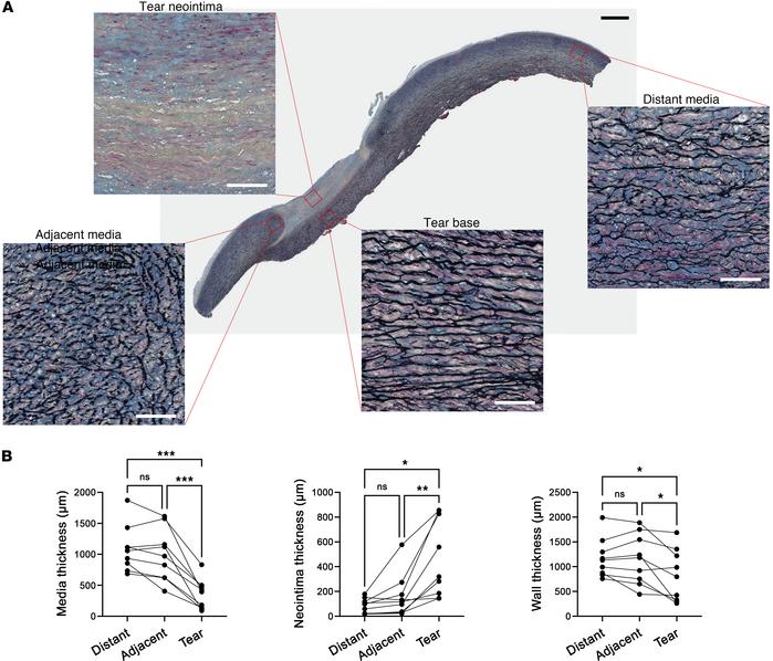 Vessel wall microstructure of intimomedial tears.
Aortas with intimomedi...