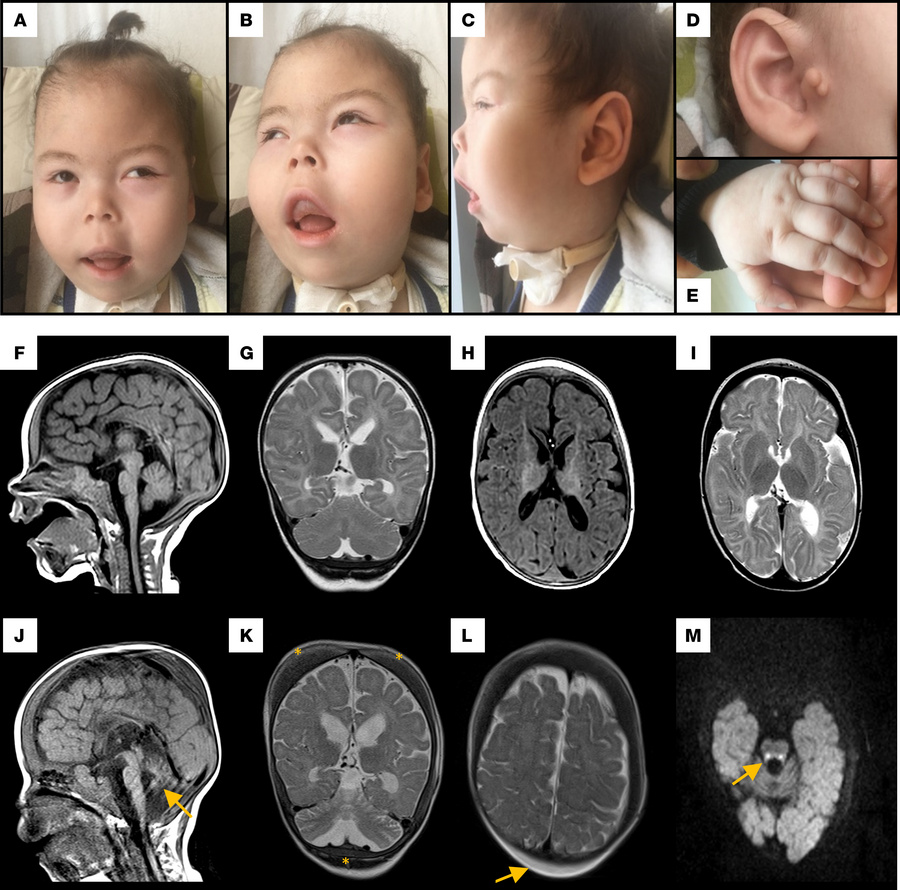 Clinical findings and MRI results of individual V-8.
(A–C) Note full che...