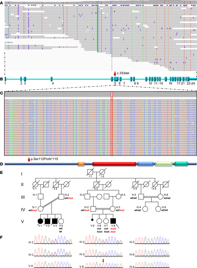Long-read genome sequencing shows the homozygous c.333del variant.
(A) L...